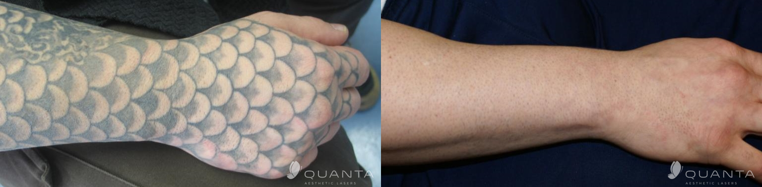 Reset Tattoo Removal – Tattoo Removal Solution