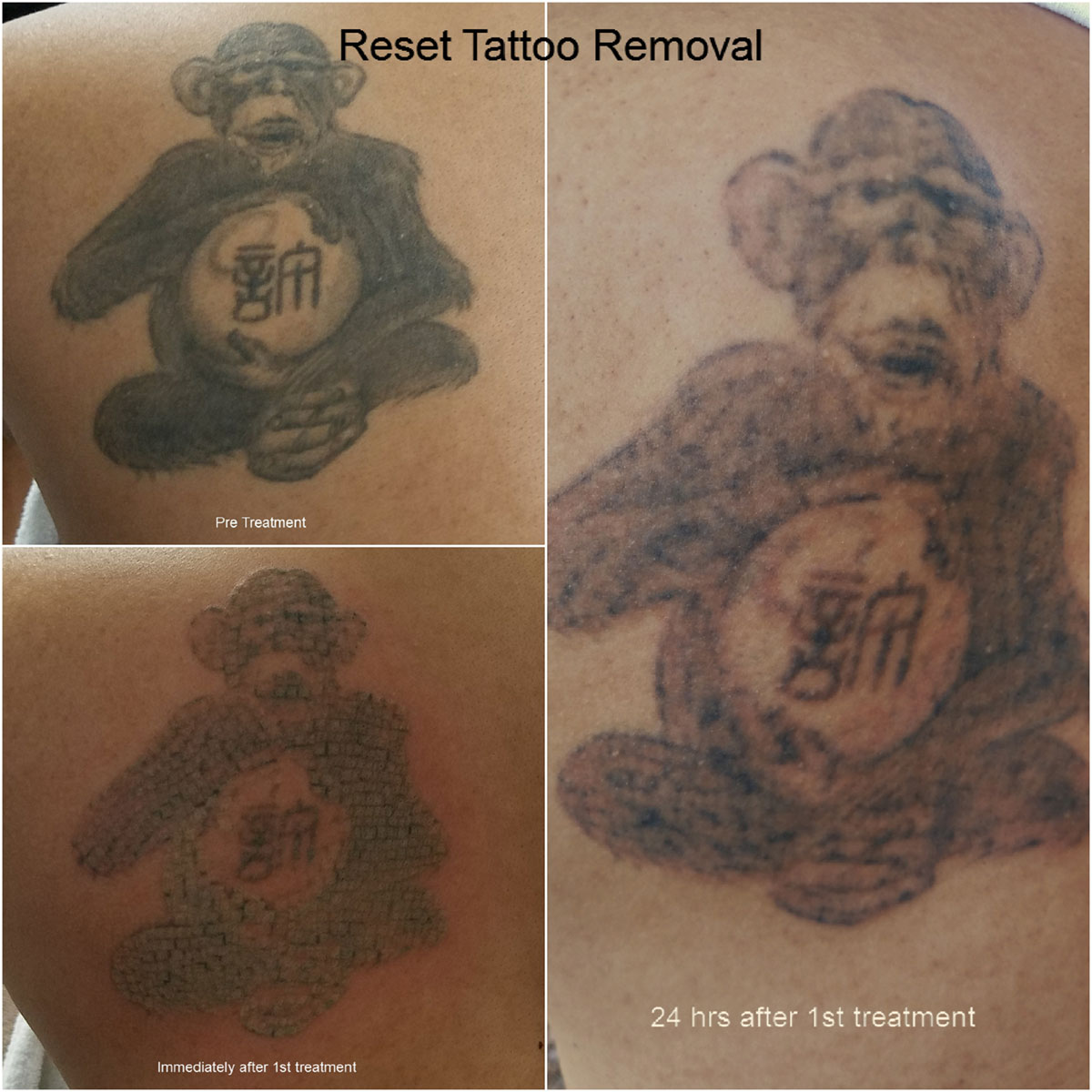 Reset Tattoo Removal – Tattoo Removal Solution